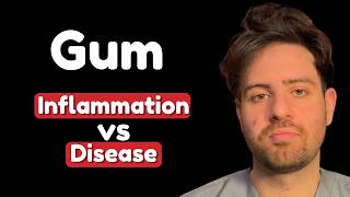 Bleeding Gums: Is It Gingivitis or GUM DISEASE? Here's How To Tell