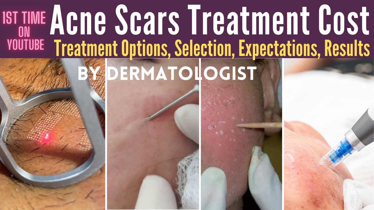 Acne Scars Treatment Cost In India Acne Scar Treatment Options