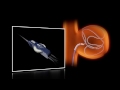 SwiftNinja® Steerable Microcatheter