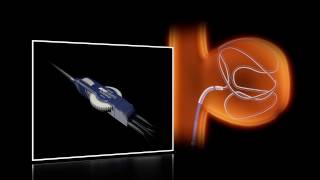 Swiftninja Steerable Microcatheter