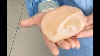 I removed my breast implants! Capsular contracture surgery