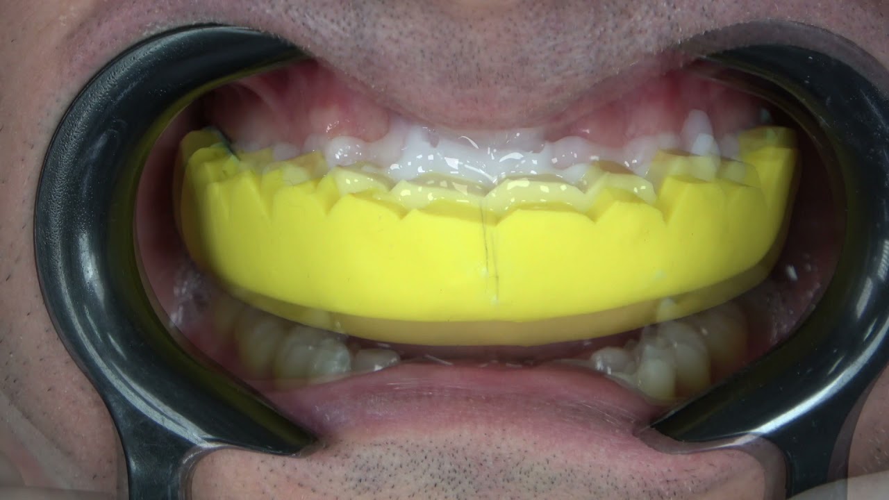 Passos clínicos para a realização de Mock-up ou ensaio restaurador