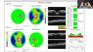 OCT and Visual Field Pearls Through Glaucoma Case Discussion