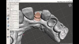 메쉬믹서로 가상발치 하기- Virtual tooth extraction : MeshMixer
