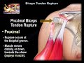 Proximal Biceps Tendon Rupture / Popeye Deformity - Everything You Need To Know - Dr. Nabil Ebraheim