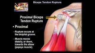 Proximal Biceps Tendon Rupture / Popeye Deformity - Everything You Need To Know - Dr. Nabil Ebraheim