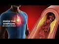 DHL-Dr Crespo-Velez -Stroke1
