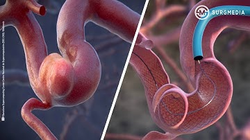 Visualization of the blood flow on an aneurysm and the effect of the embolization device.