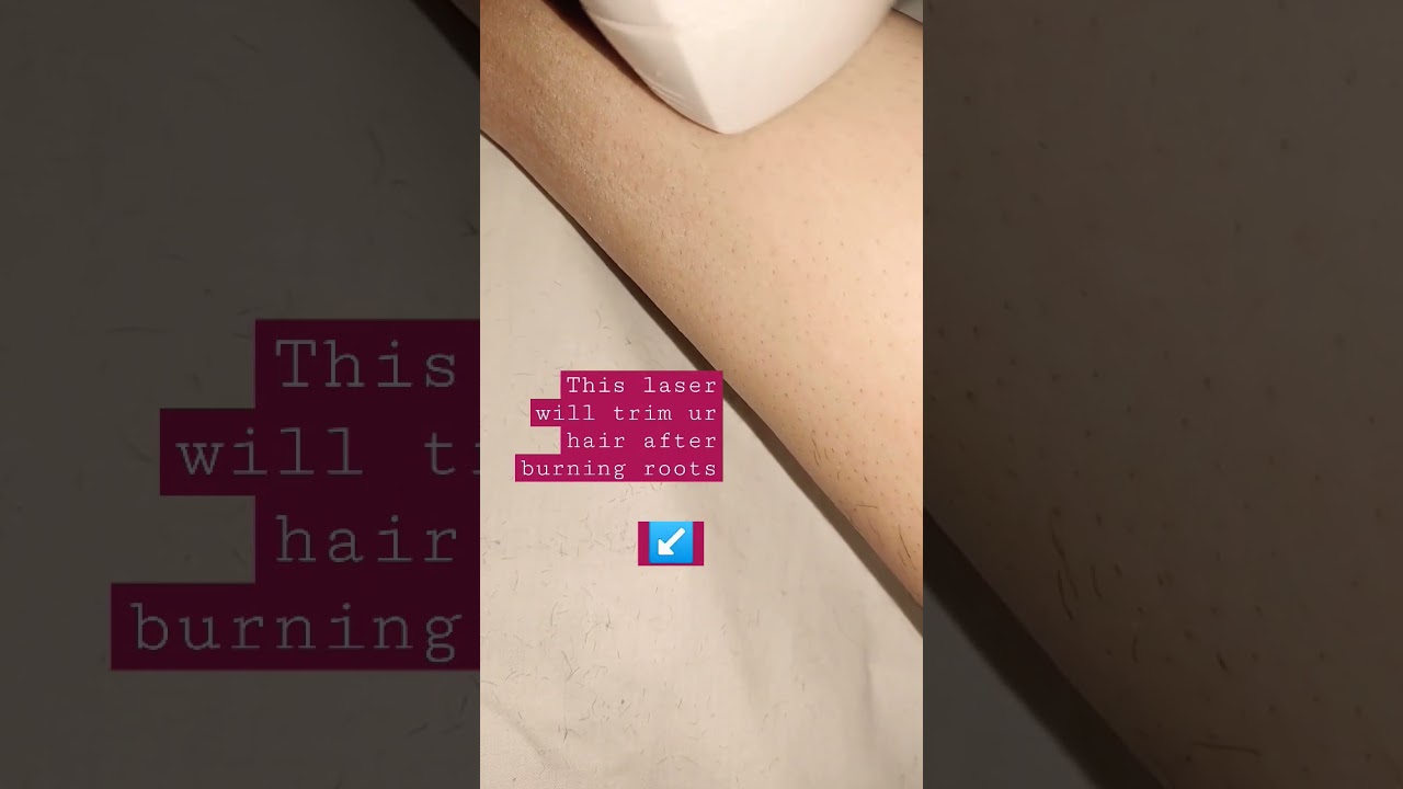 How to remove hair Permanently 