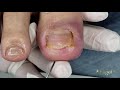 DEDO SUPER INFLAMADO │ ONICOCRIPTOSE DISTAL