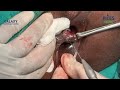 LASER HAEMORRHOIDECTOMY WITH SKIN TAG EXCISION WITH FGHAL WITH ANAL DILATION