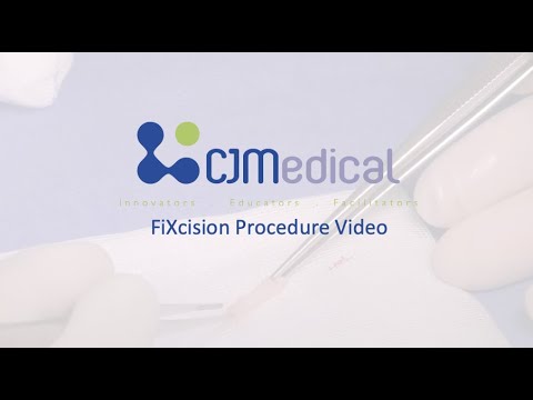 FiXcision Procedure Video