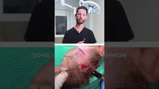 Why Fat Grafting is My Go-To Approach for Facial Volume Restoration