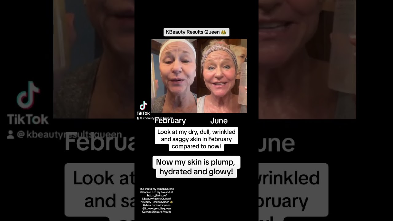 Korean Skincare Results then and now. Kbeauty Results Queen shows off! 