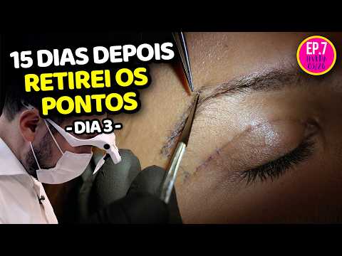 TIREI OS PONTOS - 15 DIAS DEPOIS DA CIRURGIA