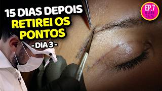 TIREI OS PONTOS - 15 DIAS DEPOIS DA CIRURGIA
