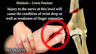 Radial Nerve Injury, Locations - Everything You Need To Know - Dr. Nabil Ebraheim