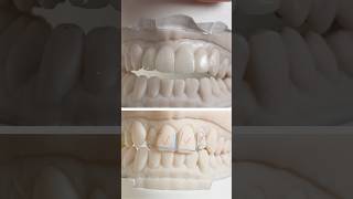 We just finished this Treatment Plan Wax-Up in my laboratory for Dr. Nelson Lo in Texas