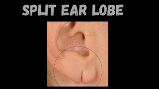 All about Split ear lobe