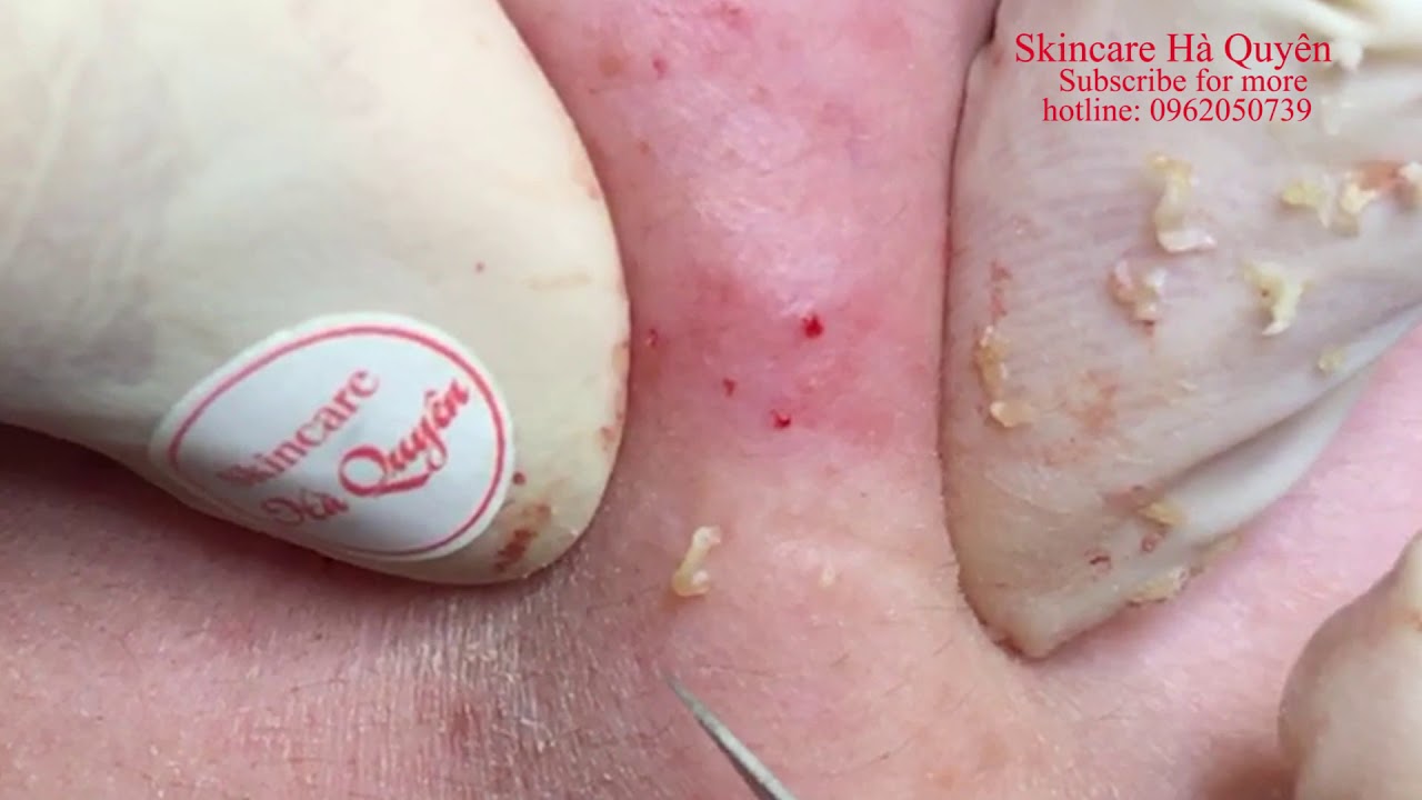 271 Blackheads and Acne treatment in Ha Quyen Spa on 06/07/2020 Điều trị mụn tại Hà Quyên