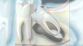 Dental Patient Education  Wisdom Teeth