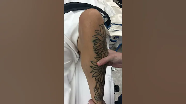 Patellar Instability Fixed With MPFL Reconstruction