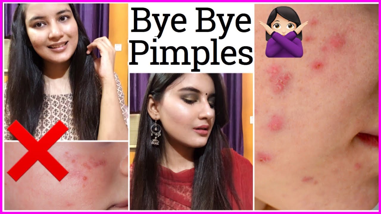 How to clean your acne face