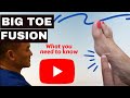 Transforming lives big toe fusion surgery   naplespodiatristcom