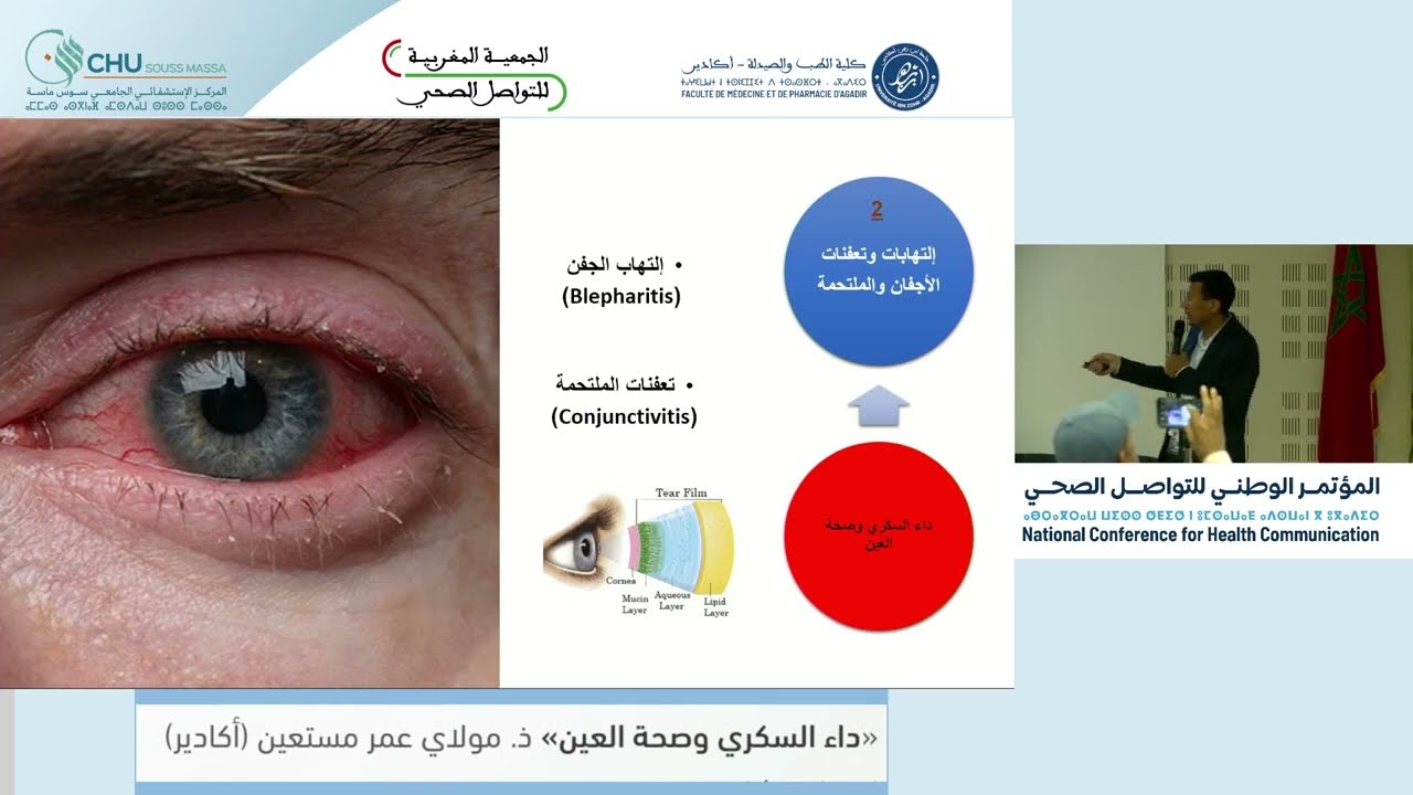 داء السكري وصحة العين ذ  مولاي عمر مستعين أكادير