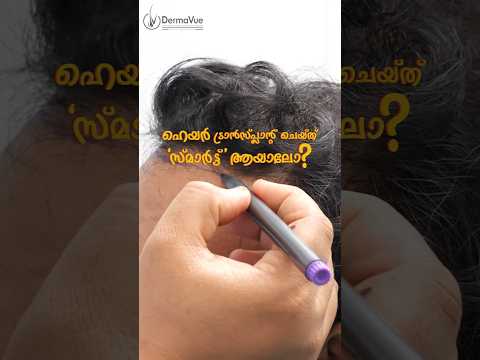 FUE Hair Transplant Procedure