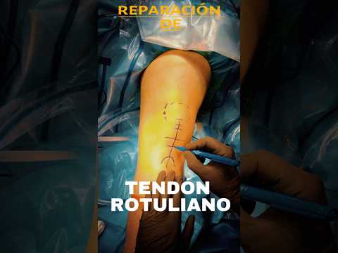 ¿Es muy larga la cirugía de tendón rotuliano?