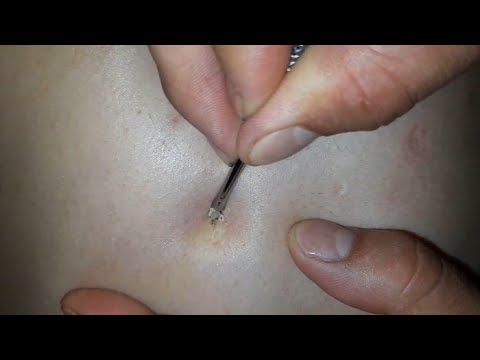 Enjoy the convenience of perfect blackhead, acne clearing and enjoy asmr massage