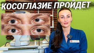 КОСОГЛАЗИЕ: виды, причины, лечение, профилактика! Как видит человек с косоглазием и что делать?