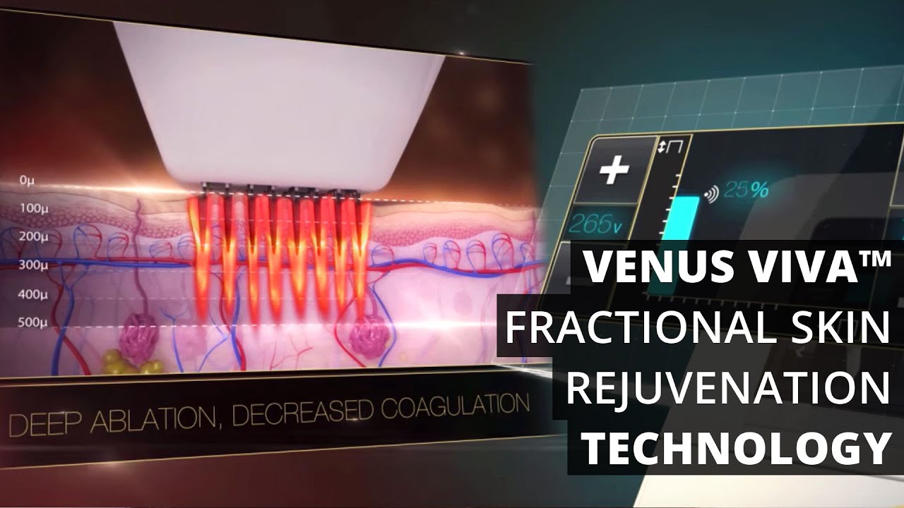 Venus Viva™ Fractional Skin Rejuvenation Technology - YouTube