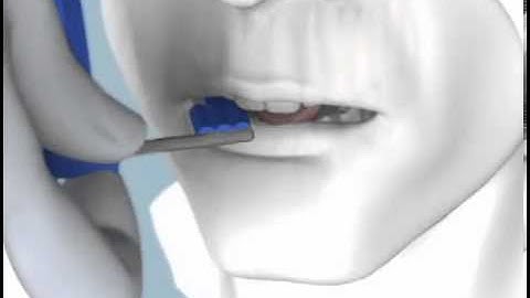 Horizontal Bitewing Sensor Placement