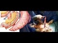 Sleeve gastrectomie  animation 3d