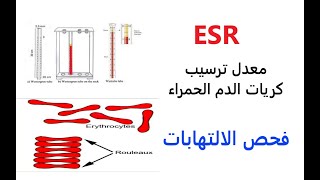 معدل ترسيب كريات الدم الحمراء | ESR | فحص الالتهابات