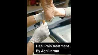 Heel Pain treatment by Agnikarma viralshorts youtubeshorts viral ayurveda agnikarma