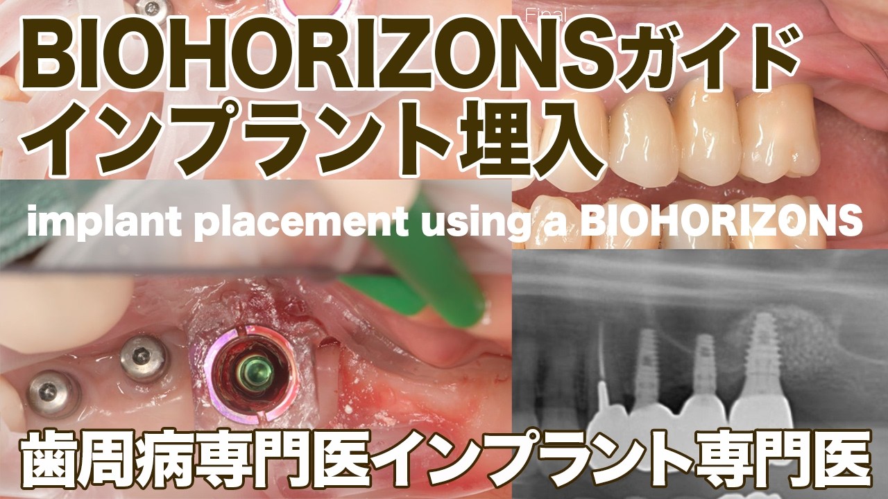 BIOHORIZONSガイドによるインプラント埋入】他院インプラント修正治療