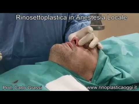 Rinosettoplastica In Anestesia Locale Indolore E Senza Tamponi Prof Carlo Grassi Youtube