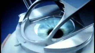 Lasik. Diferencia microquerátomo y femtosegundo