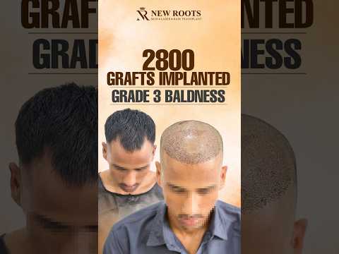 Hair Transplant in Siliguri (Grade 3 Baldness) | 2800 Grafts #hairtransplant #siliguri #shorts