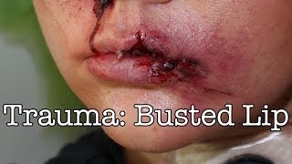 Trauma: Busted Lip