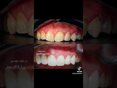عيادات بيرل الازدهار د نجد موسى من امهر اطباء الاسنان ابتسامة المشاهير ابتسامةهوليود