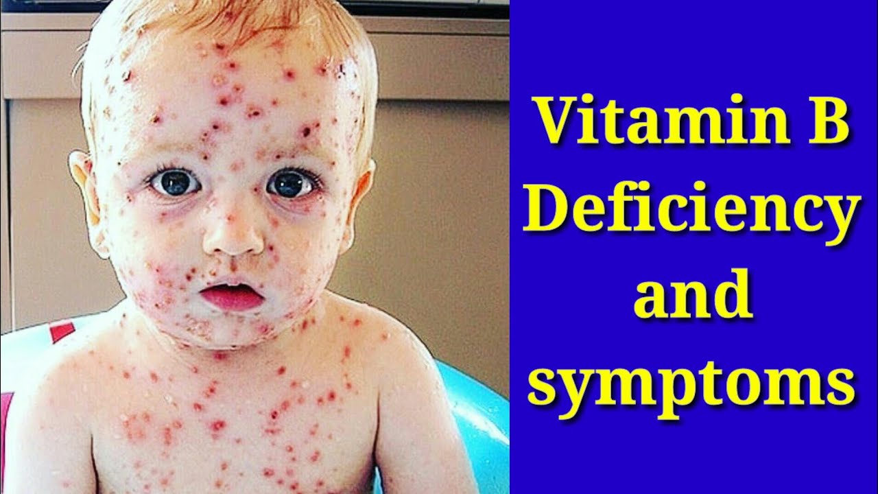 Vitamin b symptoms in hindi 