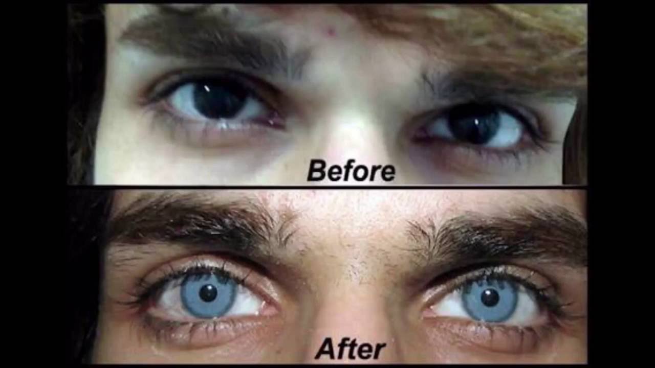 Черный пигмент глаза. Изменение цвета глаз до и после. Смена цвета глаз лазером. Изменение цвета Радужки глаз. Изменил цвет глаз.