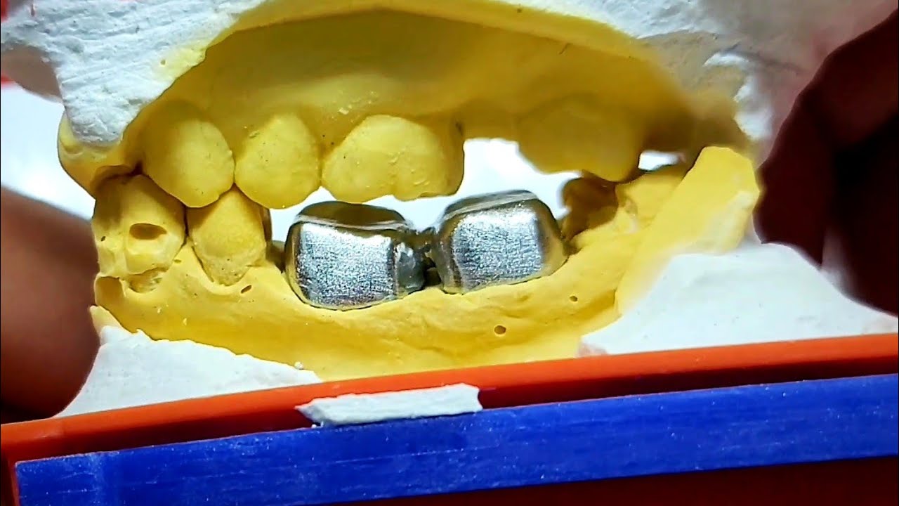 metal crowns finishing...تشذيب وإنهاء التيجان المعدنية