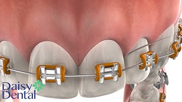 [CẬN CẢNH] QUÁ TRÌNH NIỀNG RĂNG MẮC CÀI KIM LOẠI