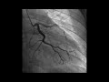 Coronarografie artera circumflexă || Dr. Pretorian