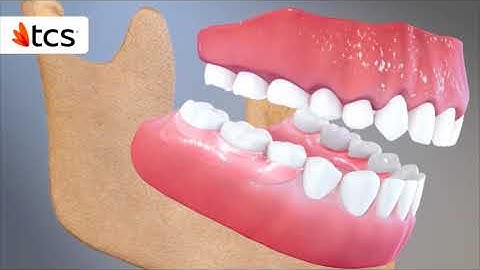 TCS Flexible Partials Animation Video